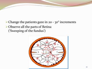 Change the patients gaze in 20 - 30° increments
Observe all the parts of Retina
(‘Sweeping of the fundus’)
43
 