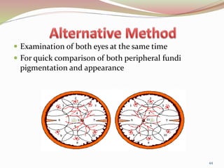  Examination of both eyes at the same time
 For quick comparison of both peripheral fundi
pigmentation and appearance
44
 