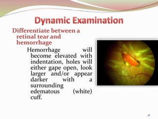 Differentiate between a
retinal tear and
hemorrhage
Hemorrhage will
become elevated with
indentation, holes will
either gape open, look
larger and/or appear
darker with a
surrounding
edematous (white)
cuff.
48
 