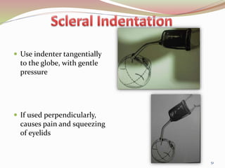  Use indenter tangentially
to the globe, with gentle
pressure
 If used perpendicularly,
causes pain and squeezing
of eyelids
51
 