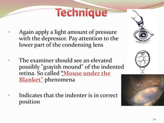• Again apply a light amount of pressure
with the depressor. Pay attention to the
lower part of the condensing lens
• The examiner should see an elevated
possibly "grayish mound" of the indented
retina. So called “Mouse under the
Blanket” phenomena
• Indicates that the indenter is in correct
position
54
 