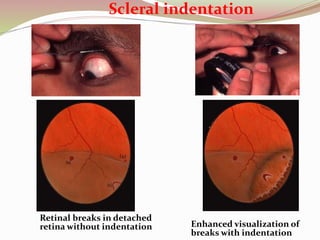 Scleral indentation
Retinal breaks in detached
retina without indentation Enhanced visualization of
breaks with indentation
 