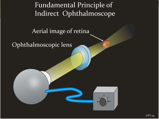 Ophthalmoscopic lens
Aerial image of retina
Fundamental Principle of
Indirect Ophthalmoscope
GTT 04
 