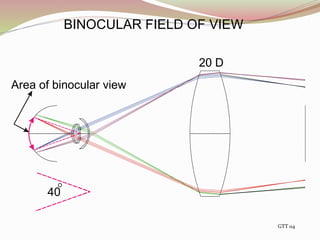 20 D
40
Area of binocular view
BINOCULAR FIELD OF VIEW
GTT 04
 