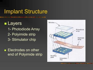 Implant Structure
 Layers
1- Photodiode Array
2- Polyimide strip
3- Stimulator chip
 Electrodes on other
end of Polyimide strip
 