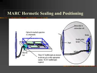 MARC Hermetic Sealing and Positioning
 