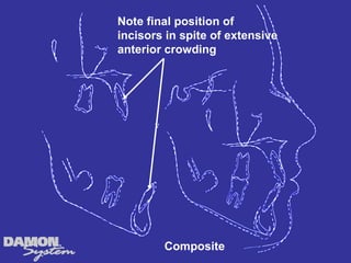 Note final position of
incisors in spite of extensive
anterior crowding




        Composite
 