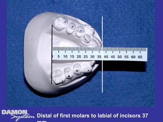 Distal of first molars to labial of incisors 37
 