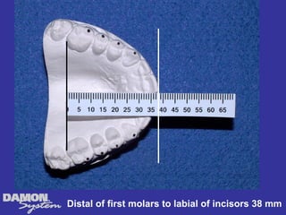 Distal of first molars to labial of incisors 38 mm
 