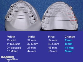 Width          Initial   Final     Change
Cuspid         32 mm     34 mm     2 mm
1st bicuspid   32.5 mm   40.5 mm   8 mm
2nd bicuspid   37 mm     48 mm     11 mm
1st Molar      44 mm     53 mm     9 mm
 