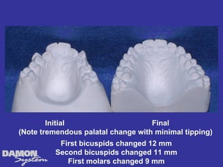 Initial                     Final
(Note tremendous palatal change with minimal tipping)
           First bicuspids changed 12 mm
          Second bicuspids changed 11 mm
             First molars changed 9 mm
 