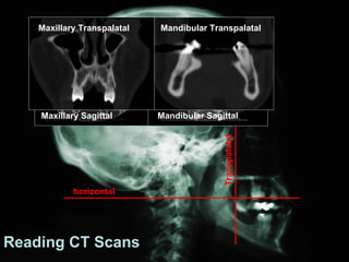 Maxillary Transpalatal   Mandibular Transpalatal




    Maxillary Sagittal       Mandibular Sagittal




                                            Transpalatal
            horizontal




Reading CT Scans
 