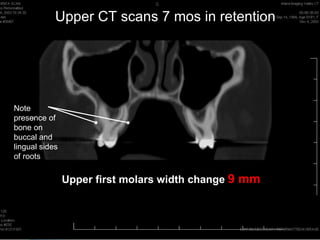 Upper CT scans 7 mos in retention




Note
presence of
bone on
buccal and
lingual sides
of roots


                Upper first molars width change 9 mm
 