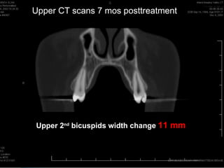 Upper CT scans 7 mos posttreatment




Upper 2nd bicuspids width change 11 mm
 