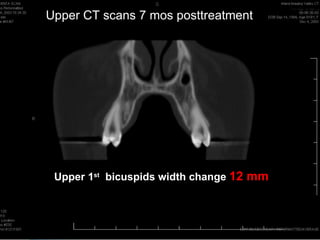 Upper CT scans 7 mos posttreatment




 Upper 1st bicuspids width change 12 mm
 