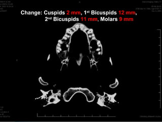 Change: Cuspids 2 mm, 1st Bicuspids 12 mm,
        2nd Bicuspids 11 mm, Molars 9 mm
 