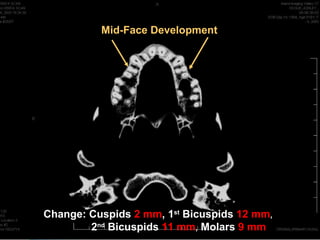 Mid-Face Development




Change: Cuspids 2 mm, 1st Bicuspids 12 mm,
        2nd Bicuspids 11 mm, Molars 9 mm
 