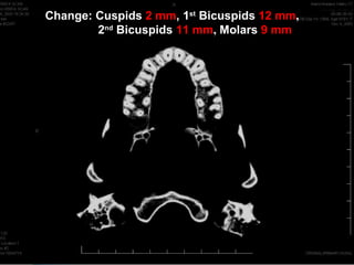 Change: Cuspids 2 mm, 1st Bicuspids 12 mm,
        2nd Bicuspids 11 mm, Molars 9 mm
 