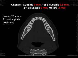 Change: Cuspids 0 mm, 1st Bicuspids 2.5 mm,
              2nd Bicuspids 2 mm, Molars .5 mm


Lower CT scans
7 months post-
treatment
 