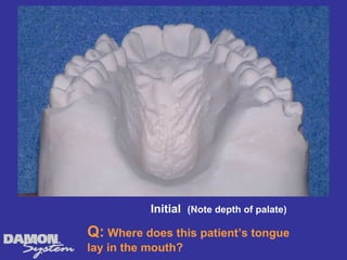 Initial (Note depth of palate)

Q: Where does this patient’s tongue
lay in the mouth?
 