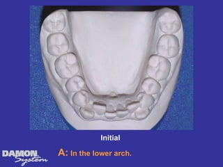 Initial

A: In the lower arch.
 