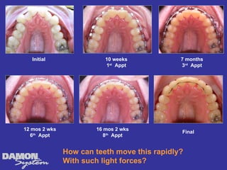 Initial                10 weeks            7 months
                          1st Appt            3rd Appt




12 mos 2 wks           16 mos 2 wks
                                              Final
   6th Appt               8th Appt


               How can teeth move this rapidly?
               With such light forces?
 