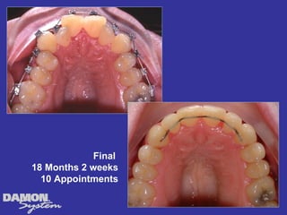 Final
18 Months 2 weeks
  10 Appointments
 