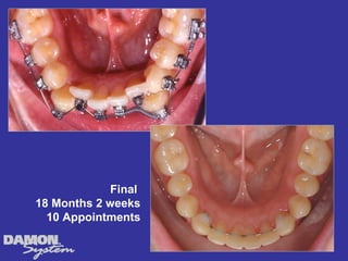 Final
18 Months 2 weeks
  10 Appointments
 