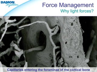Force Management
                                   Why light forces?




Capillaries entering the foraminae of the cortical bone
 