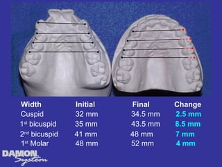 Width          Initial   Final     Change
Cuspid         32 mm     34.5 mm   2.5 mm
1st bicuspid   35 mm     43.5 mm   8.5 mm
2nd bicuspid   41 mm     48 mm     7 mm
1st Molar      48 mm     52 mm     4 mm
 