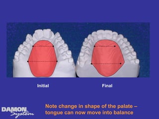 Initial                   Final



    Note change in shape of the palate –
    tongue can now move into balance
 