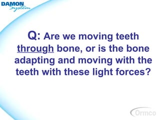 Q: Are we moving teeth
through bone, or is the bone
adapting and moving with the
teeth with these light forces?
 