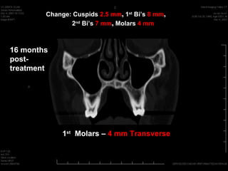 Change: Cuspids 2.5 mm, 1st Bi’s 8 mm,
               2nd Bi’s 7 mm, Molars 4 mm



16 months
post-
treatment




             1st Molars – 4 mm Transverse
 