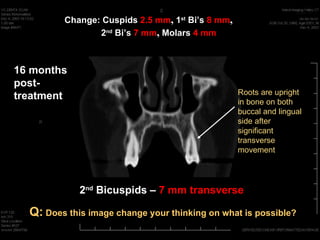 Change: Cuspids 2.5 mm, 1st Bi’s 8 mm,
                2nd Bi’s 7 mm, Molars 4 mm



16 months
post-
                                                  Roots are upright
treatment                                         in bone on both
                                                  buccal and lingual
                                                  side after
                                                  significant
                                                  transverse
                                                  movement




             2nd Bicuspids – 7 mm transverse

  Q: Does this image change your thinking on what is possible?
 
