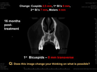 Change: Cuspids 2.5 mm, 1st Bi’s 8 mm,
                2nd Bi’s 7 mm, Molars 4 mm



16 months
post-
treatment




            1st Bicuspids – 8 mm transverse
  Q: Does this image change your thinking on what is possible?
 