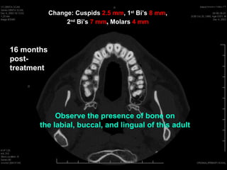 Change: Cuspids 2.5 mm, 1st Bi’s 8 mm,
                 2nd Bi’s 7 mm, Molars 4 mm



16 months
post-
treatment




            Observe the presence of bone on
       the labial, buccal, and lingual of this adult
 