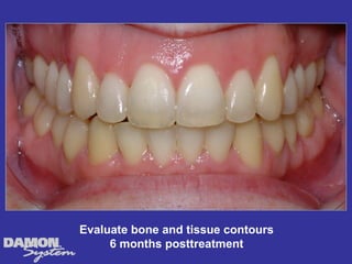 Evaluate bone and tissue contours
     6 months posttreatment
 