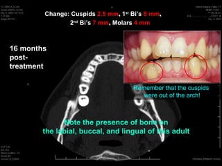 Change: Cuspids 2.5 mm, 1st Bi’s 8 mm,
               2nd Bi’s 7 mm, Molars 4 mm



16 months
post-
treatment

                                    Remember that the cuspids
                                       were out of the arch!



              Note the presence of bone on
        the labial, buccal, and lingual of this adult
 