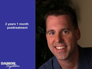 2 years 1 month
 posttreatment
 