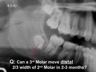 4-2-03




 Q: Can a 3rd Molar move distal
   2/3 width of 2nd Molar in 2-3 months?
 