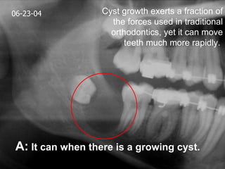 06-23-04          Cyst growth exerts a fraction of
                    the forces used in traditional
                    orthodontics, yet it can move
                        teeth much more rapidly.




A: It can when there is a growing cyst.
 