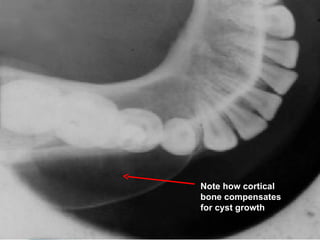 Note how cortical
bone compensates
for cyst growth
 