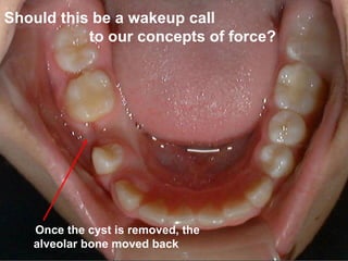 Should this be a wakeup call
           to our concepts of force?




   Once the cyst is removed, the
   alveolar bone moved back
 