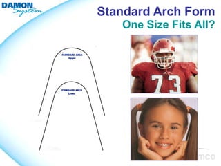 Standard Arch Form
   One Size Fits All?
 