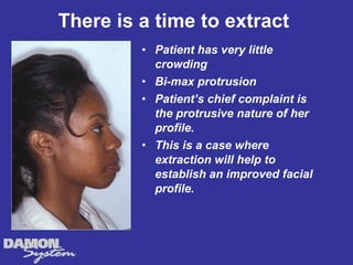 There is a time to extract
         • Patient has very little
           crowding
         • Bi-max protrusion
         • Patient’s chief complaint is
           the protrusive nature of her
           profile.
         • This is a case where
           extraction will help to
           establish an improved facial
           profile.
 