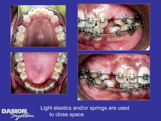 Light elastics and/or springs are used
    to close space
 