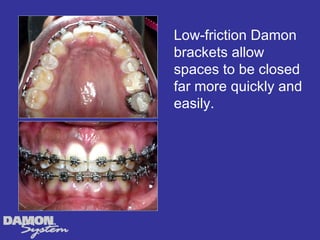 Low-friction Damon
brackets allow
spaces to be closed
far more quickly and
easily.
 