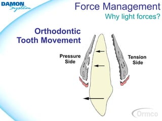 Force Management
                  Why light forces?

    Orthodontic
Tooth Movement
 