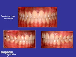 Treatment time:
   21 months
 