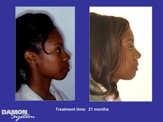 Treatment time: 21 months
 